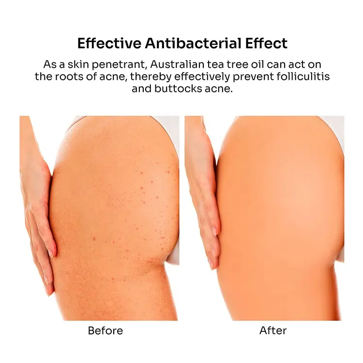 New Trends OEM Butt Acne Clearing Lotion Reduce Acne Pimples, Balance Skin Buttock Cream 796