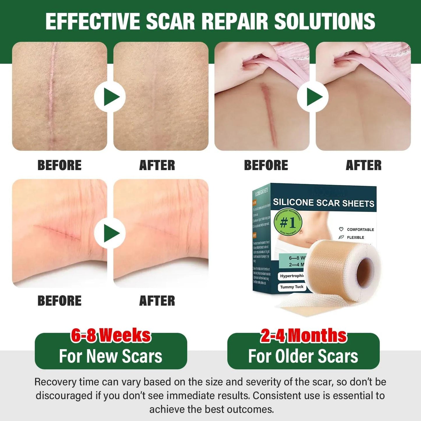 Private Label Scar Keloid Bump Removal Tape Silicone Scar Sheets For Surgical Scars (1.6"x 60" Roll-1.5M) 963