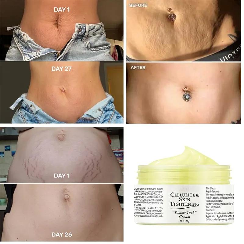 OEM ODM Organic Deep Scar Removing Treatment Repair Anti Pimples Acne Stretch Marks Scar Removal Cream Tummy Tuck Cream 1000