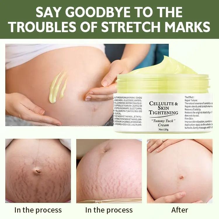 OEM ODM Organic Deep Scar Removing Treatment Repair Anti Pimples Acne Stretch Marks Scar Removal Cream Tummy Tuck Cream 1000