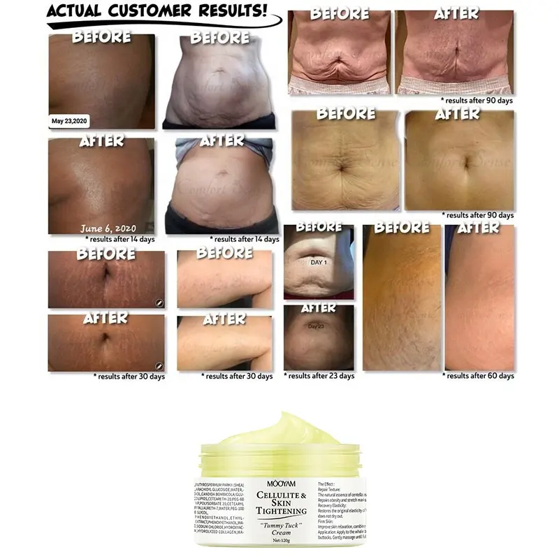 OEM ODM Organic Deep Scar Removing Treatment Repair Anti Pimples Acne Stretch Marks Scar Removal Cream Tummy Tuck Cream 1000