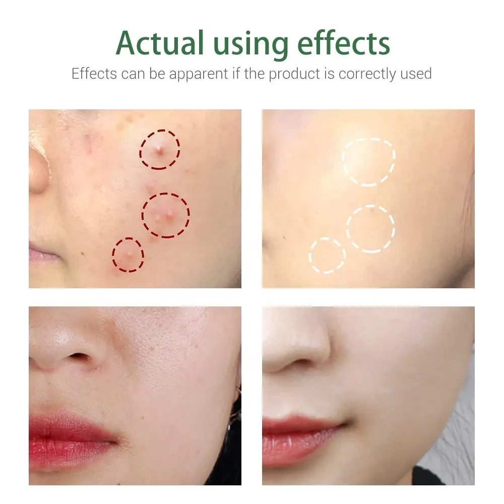 Tea Tree & Neem Anti Acne Foaming Face Wash Facial Acne Treatment Cleanser Remove Blackhead Bubble Shrink Pore Acne Facial Wash 1046