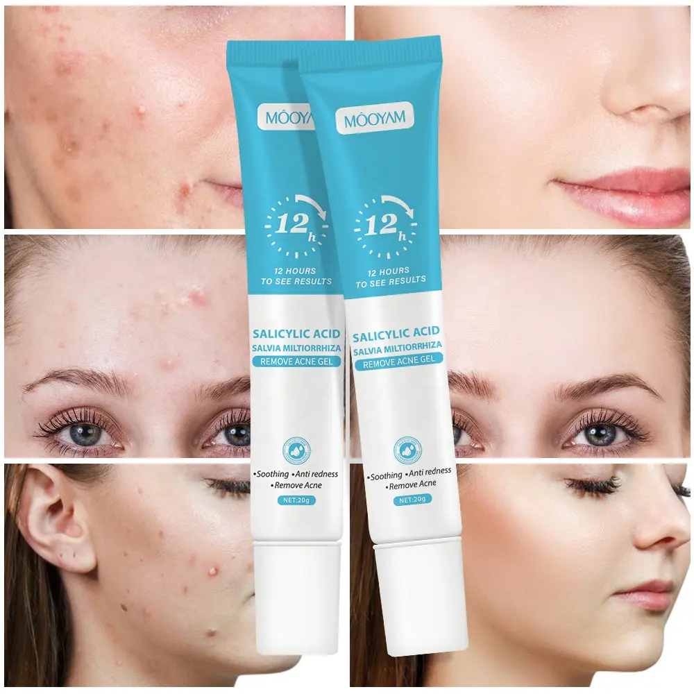 Private label quick anti acne salicylic acid face gel pimples scars treatment herbal acne removal gel 1085