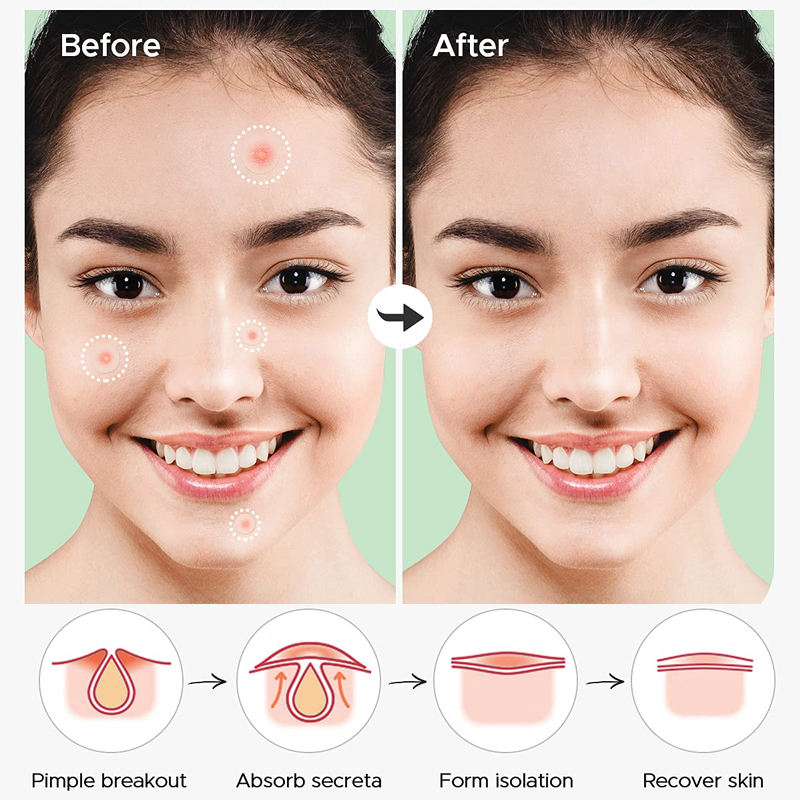 Custom 15g Hydrocolloid Spot Patch for Acne Pimple Healing Private Label Household Use Beauty & Personal Care Product