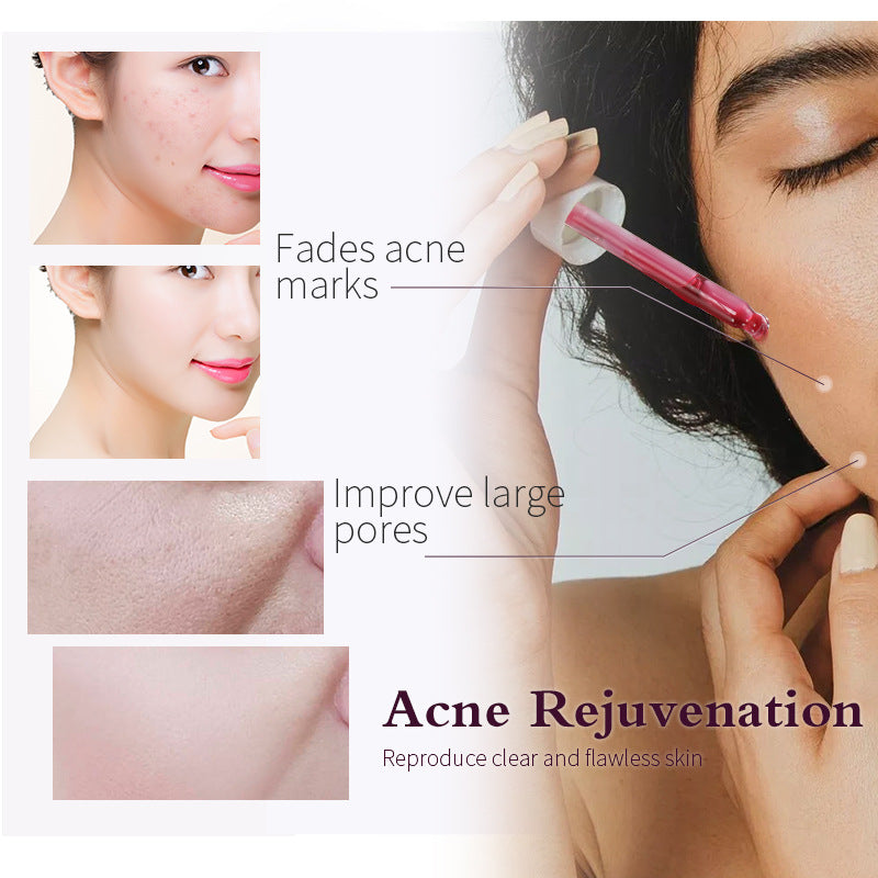 OEM Customized AHA/ BHA Essence, Cleans Pores, Softens Cuticles, Repairs Facial Acne Skin, Fruit acid Serum 150