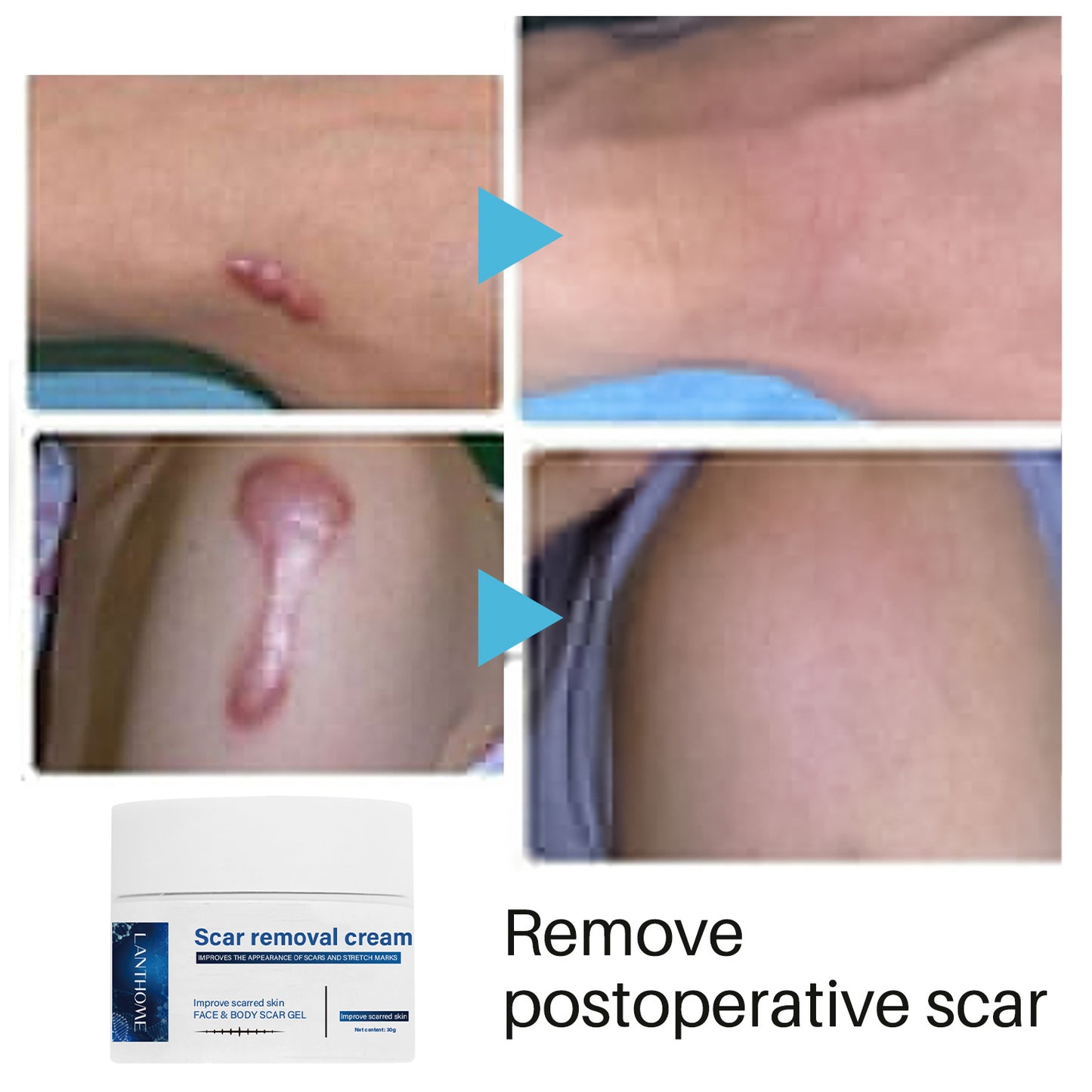 Private Label Wholesale Light Scar Cream, Body Care, Repairing Fine Scars, Removal Scare Cream 371