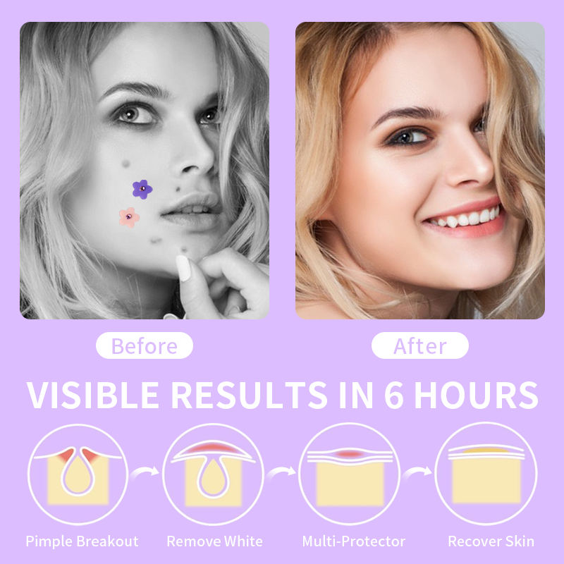 OEM Star and Heart Shape Pimple Remove Patch Hydrocolloid Acne Absorbing Cover Patches Acne