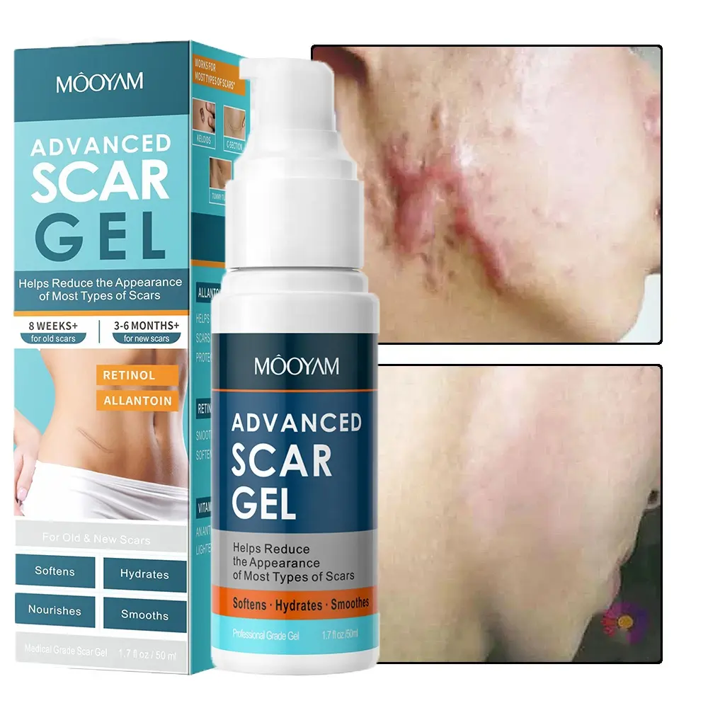 Strong Effective Acne Scar Removal Gel Pimples Stretch Marks Remove Face Gel Tummy Tuck Tightening Advanced Scar Gel 724