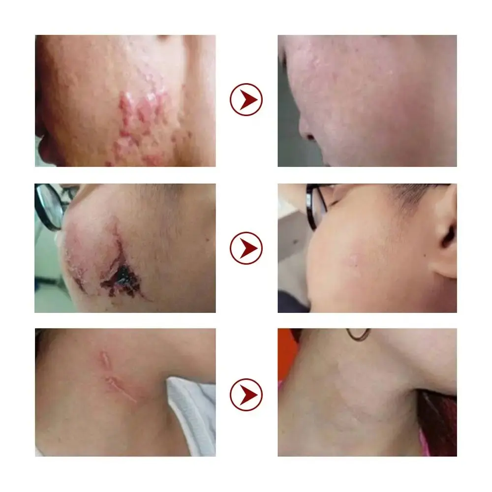 Strong Effective Acne Scar Removal Gel Pimples Stretch Marks Remove Face Gel Tummy Tuck Tightening Advanced Scar Gel 724