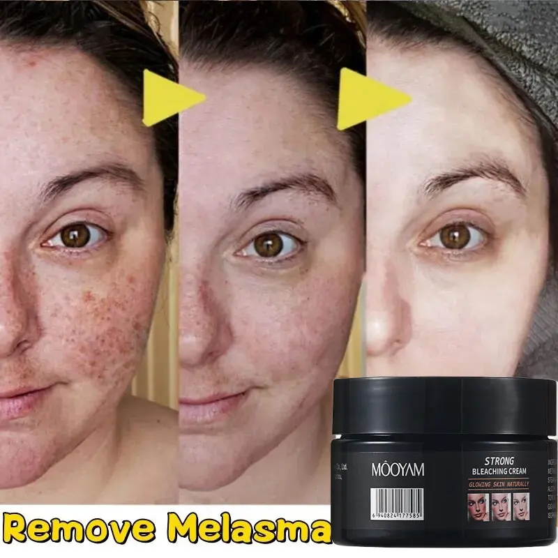 120g Skin Powerful Whitening Freckle Cream Remove Melasma Acne Spots Pigment Melanin Dark Spots Face Strong Bleaching Cream 738