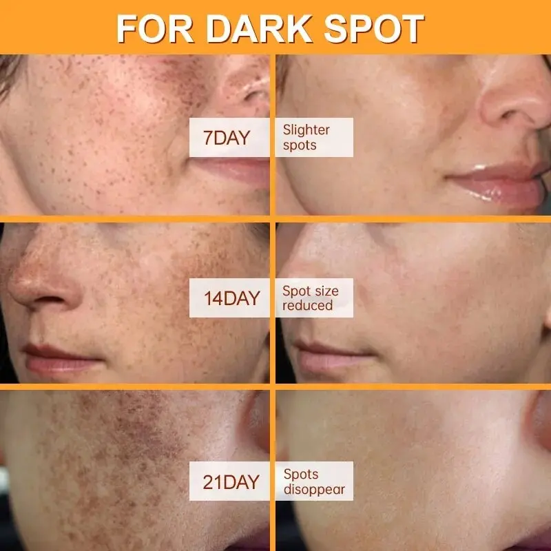 120g Skin Powerful Whitening Freckle Cream Remove Melasma Acne Spots Pigment Melanin Dark Spots Face Strong Bleaching Cream 738