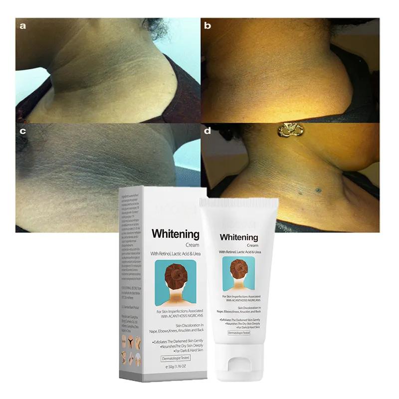 Remove Black Patches Whitening Cream Acanthosis Nigricans Knee Elbow Neck Underarm Whitening Cream 776