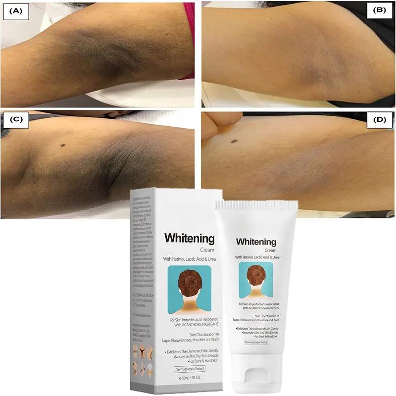 Remove Black Patches Whitening Cream Acanthosis Nigricans Knee Elbow Neck Underarm Whitening Cream 776