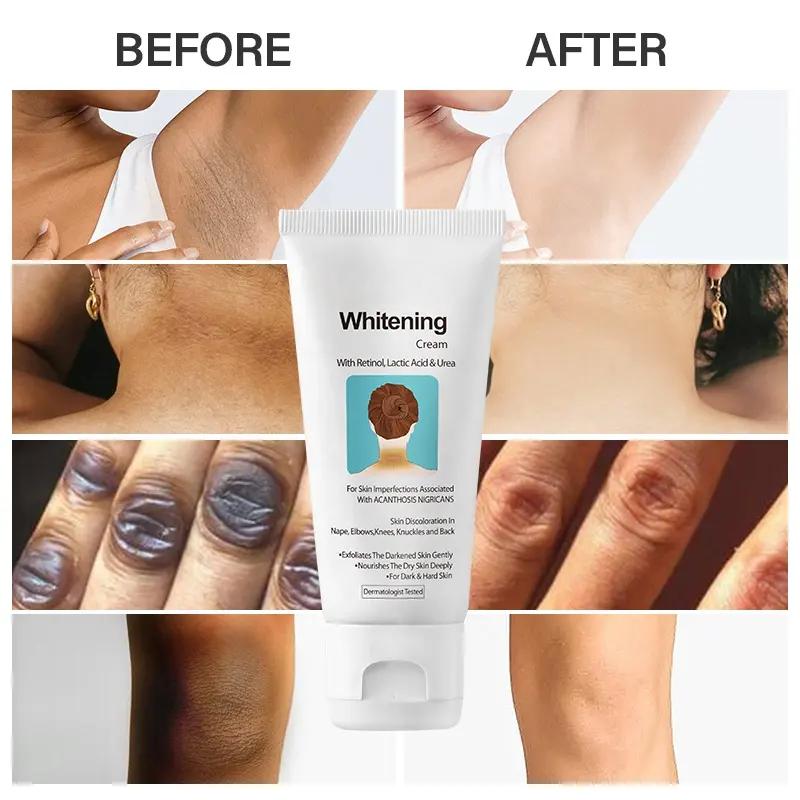 Remove Black Patches Whitening Cream Acanthosis Nigricans Knee Elbow Neck Underarm Whitening Cream 776