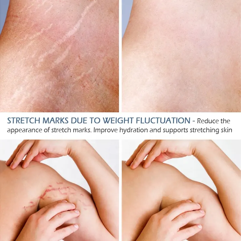 Private Label Stretch Marks Essential Oil Scar Oil 100% Natural Pure Plant Extract 7 Days Stretch Mark Removal Oil 798