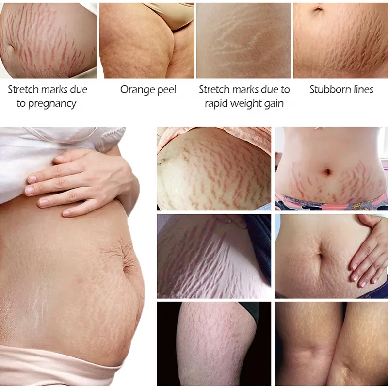 Private Label Stretch Marks Essential Oil Scar Oil 100% Natural Pure Plant Extract 7 Days Stretch Mark Removal Oil 798