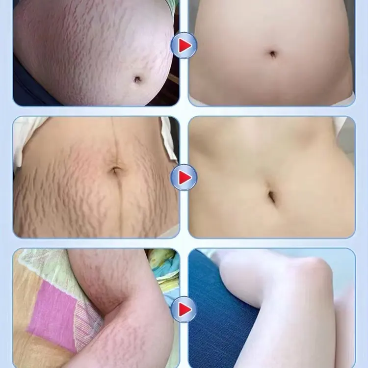 Pregnancy Scars Remove Stretch Marks Oil Treatment Maternity Repair Anti-Aging Anti-Wrinkles Firming Stretch Mark Body Oil 918