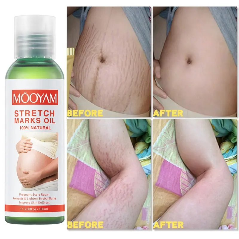 Pregnancy Scars Remove Stretch Marks Oil Treatment Maternity Repair Anti-Aging Anti-Wrinkles Firming Stretch Mark Body Oil 918