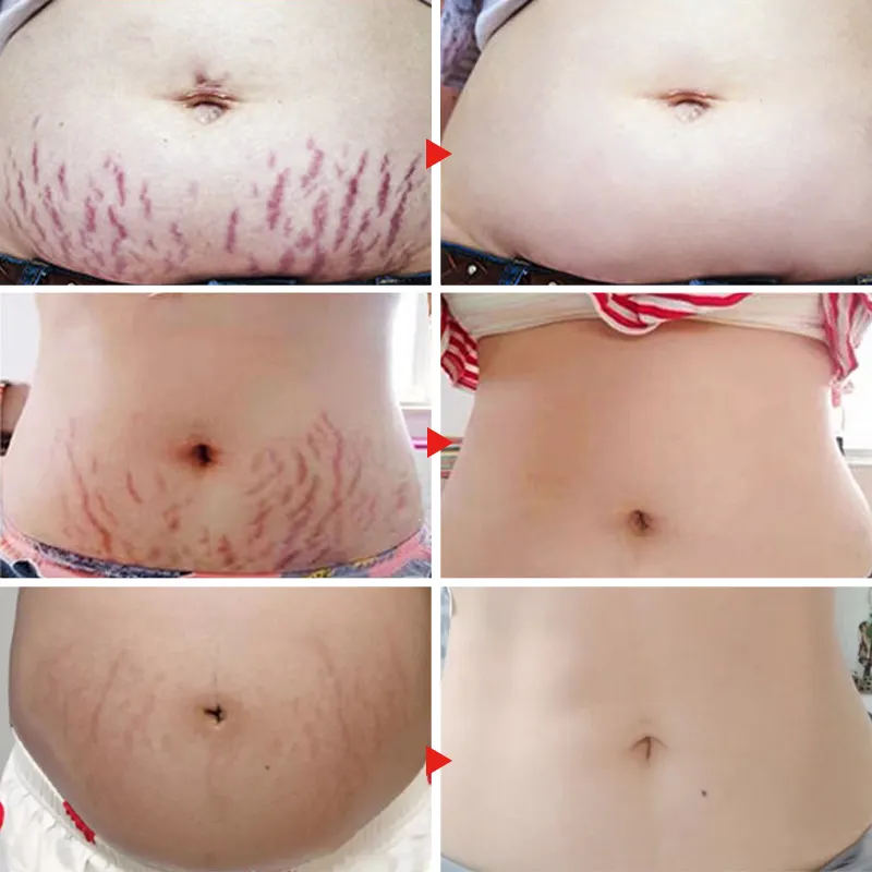 Wholesale Customize OEM stretch marks removal cream natural rose best effective repairing pregnant belly mark cream 1001